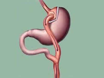 bypass gastrico ambato