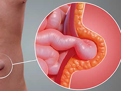 HERNIAS ambato